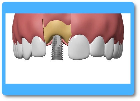 implant dentaire Pont à Mousson